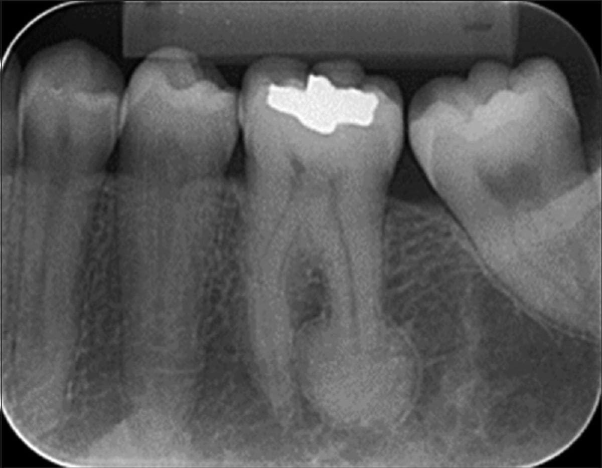 X-ray Showing Root Canal Therapy - Southborough Dental Partners Revitalizing Teeth and Bone: The Impact of Root Canal Therapy