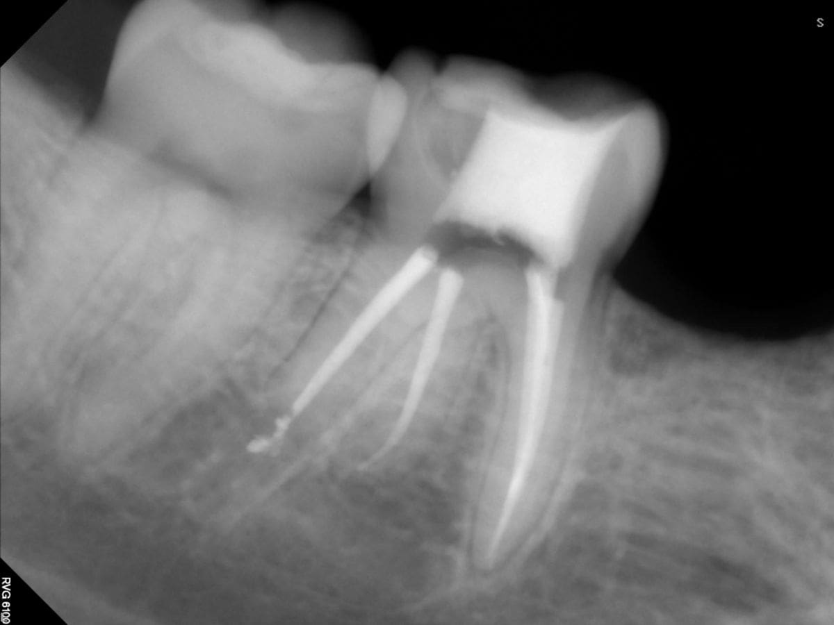 The Hidden Culprit: Dental Abscess and Abscessed Tooth. Root canal Therapy